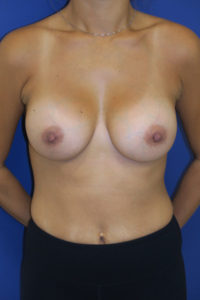 inframammary breast augmentation patient