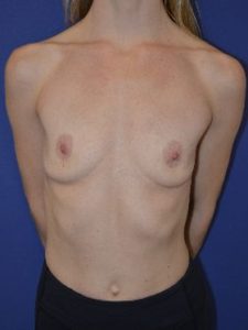 inframammary breast augmentation patient