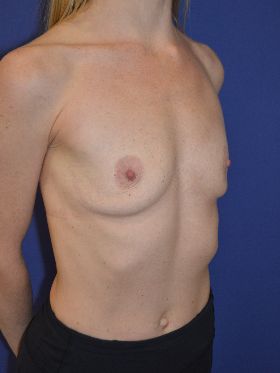 inframammary breast augmentation patient