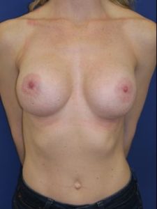 inframammary breast augmentation patient