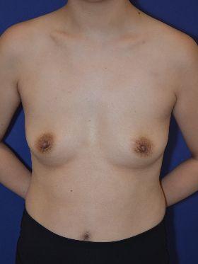 inframammary breast augmentation patient