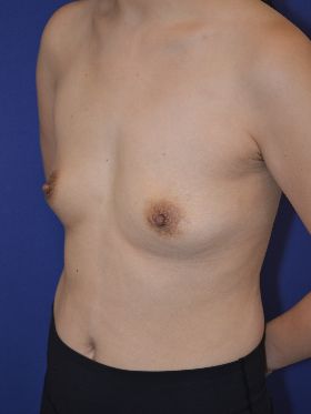 inframammary breast augmentation patient