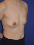 inframammary breast augmentation patient