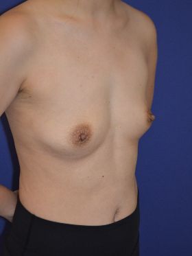 inframammary breast augmentation patient
