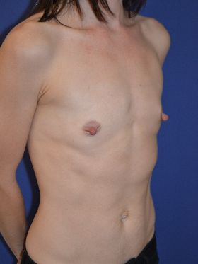 inframammary breast augmentation patient