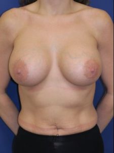inframammary breast augmentation patient