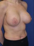 inframammary breast augmentation patient