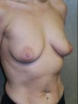 inframammary breast augmentation patient
