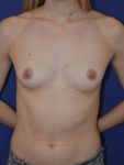 inframammary breast augmentation patient