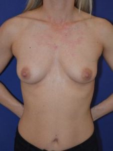 inframammary breast augmentation patient