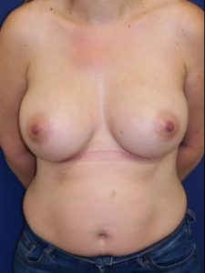 inframammary breast augmentation patient