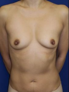 inframammary breast augmentation patient