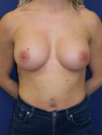 inframammary breast augmentation patient