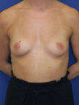 inframammary breast augmentation patient