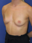 inframammary breast augmentation patient