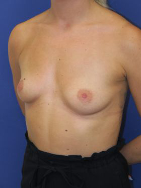 inframammary breast augmentation patient