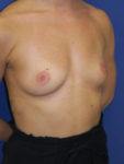 inframammary breast augmentation patient