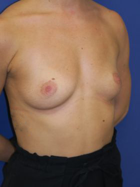 inframammary breast augmentation patient
