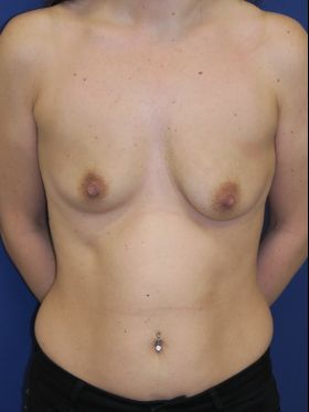 inframammary breast augmentation patient