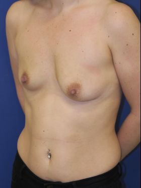 inframammary breast augmentation patient