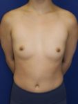 inframammary breast augmentation patient