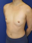 inframammary breast augmentation patient