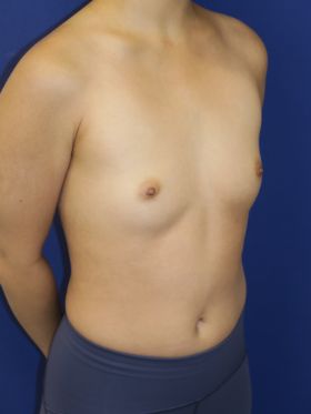 inframammary breast augmentation patient