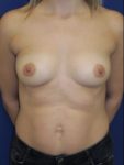 inframammary breast augmentation patient