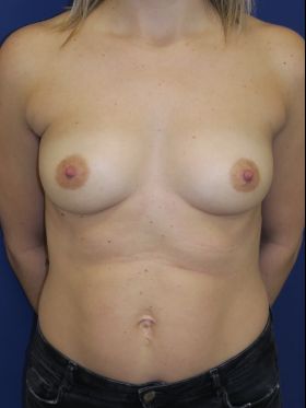 inframammary breast augmentation patient