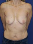 inframammary breast augmentation patient