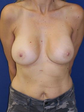 inframammary breast augmentation patient