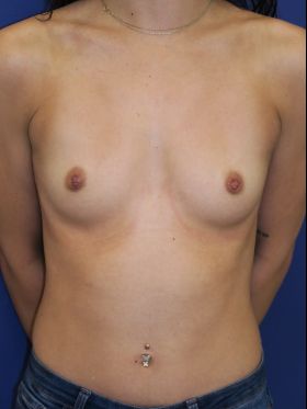 inframammary breast augmentation patient