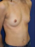 inframammary breast augmentation patient
