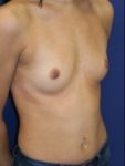 inframammary breast augmentation patient