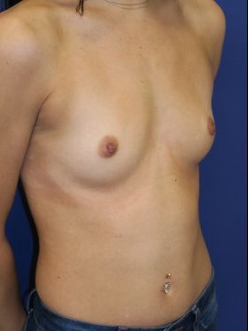inframammary breast augmentation patient