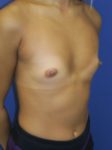 inframammary breast augmentation patient