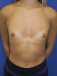 inframammary breast augmentation patient
