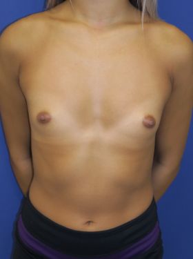 inframammary breast augmentation patient