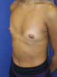 inframammary breast augmentation patient