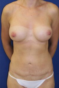 after mommy makeover patient front view case 5193