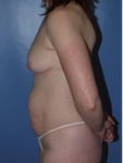 before mommy makeover patient left side view case 5224