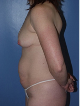 before mommy makeover patient left side view case 5224