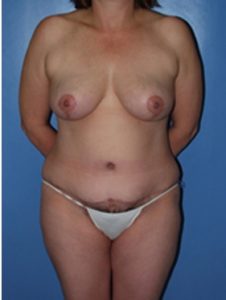 after mommy makeover patient front view case 5232