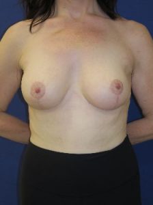 after breast lift with implants front view case 6303