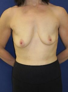 before breast lift with implants front view case 6303