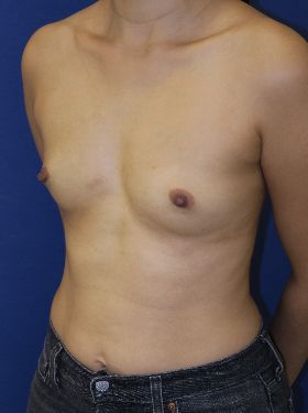 before breast augmentation left angle view case 6473