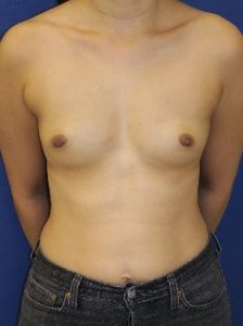 before breast augmentation front view case 6473